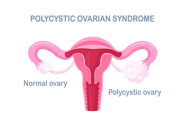 Polycystic Ovary Syndrome (PCOS)