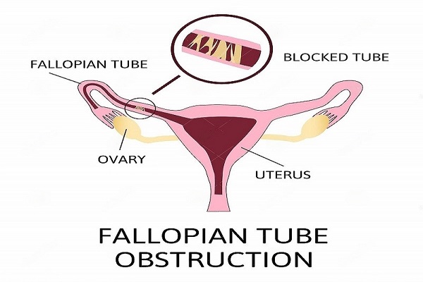 Blocked Fallopian Tubes