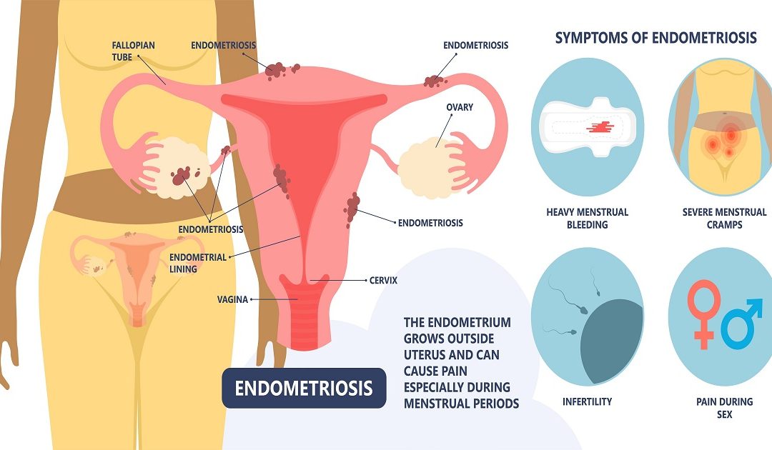 What is Endometriosis: Symptoms & Treatment