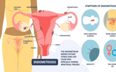 What is Endometriosis: Symptoms & Treatment