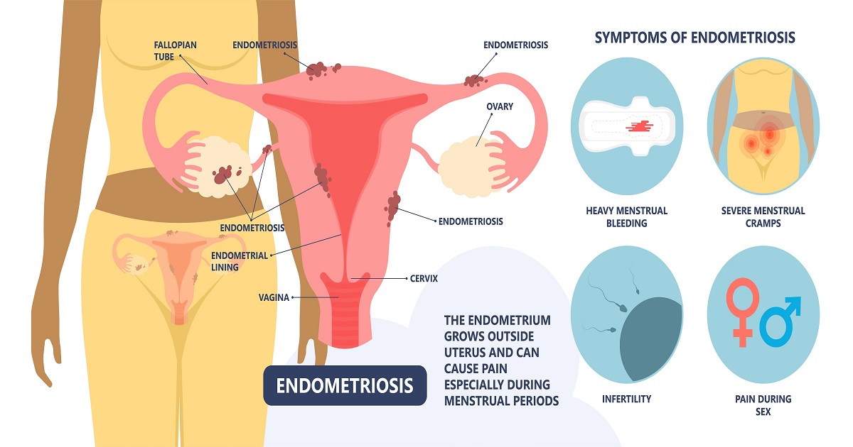 What is Endometriosis: Symptoms, Causes & Treatment