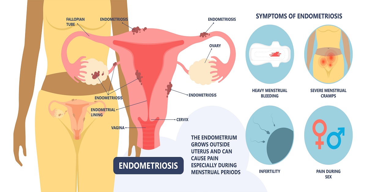 Endometriosis - Types, Symptoms, Causes and treatment