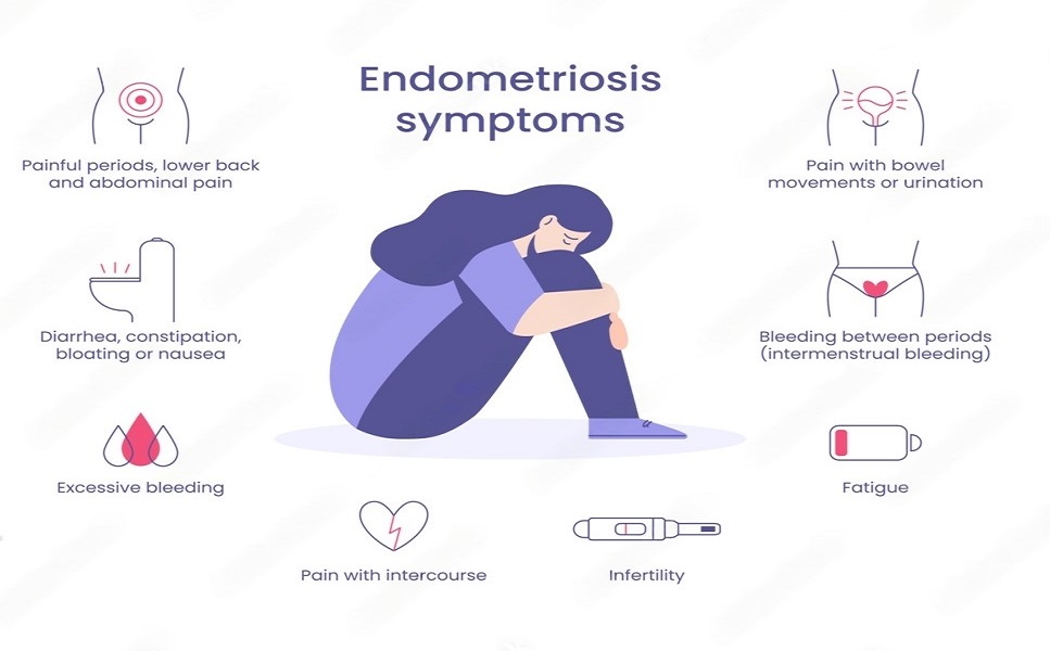 ENDOMETRIOSIS SYMPTOMS