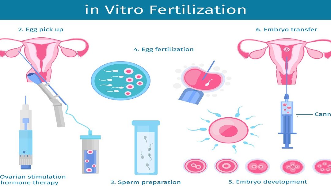 IVF Procedure Step By Step: IVF Process Start to Finish