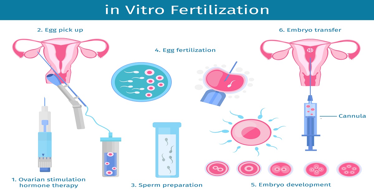 IVF Process | IVF PROCEDURE