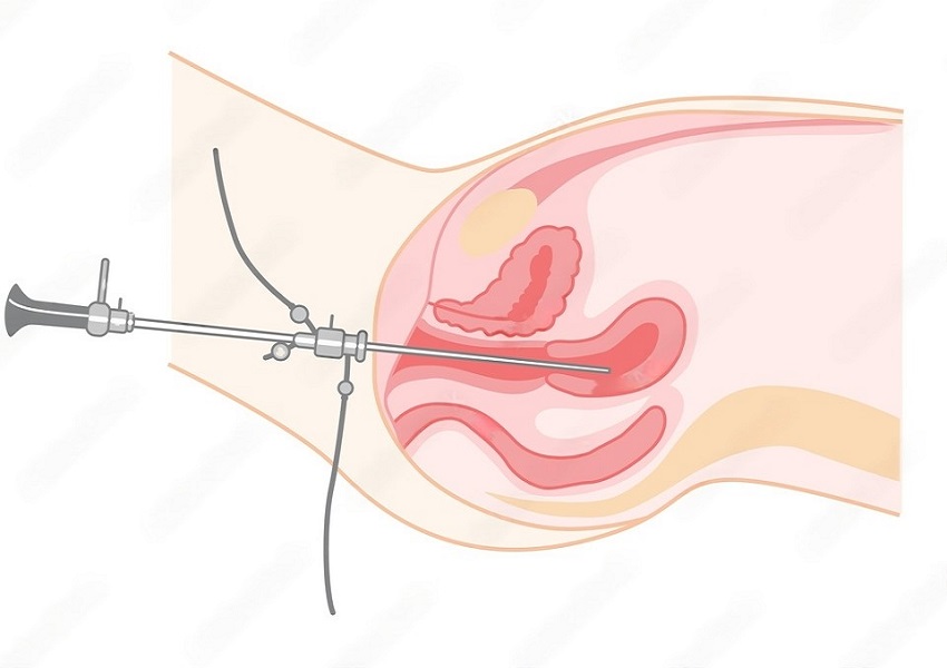 What Is a Hysteroscopy