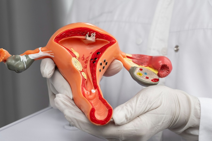 Bulky Uterus Bulky Uterus