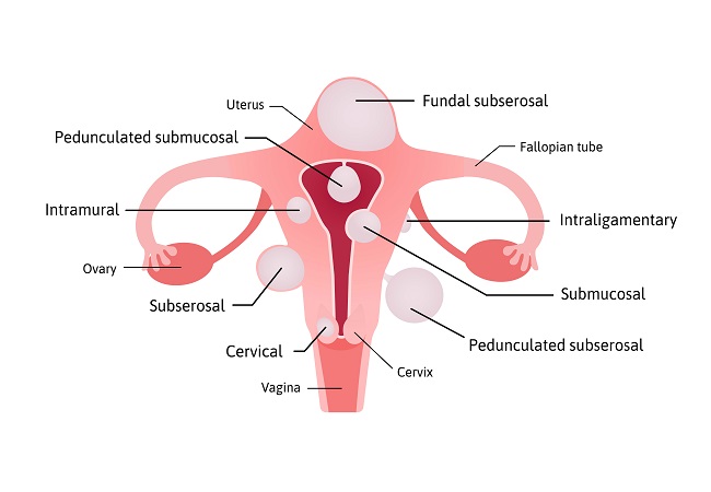 Ovary Meaning in Hindi