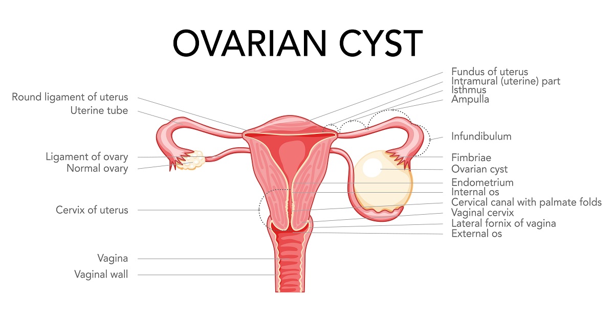 Cyst Meaning in Hindi (Cyst Kya Hota Hai)