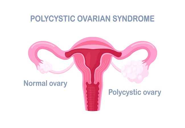 PCOD (Polycystic Ovarian Disease)