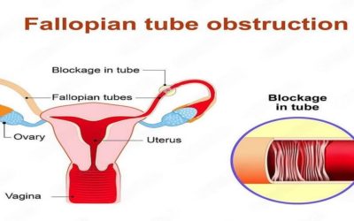 8 Steps To Get Pregnant With Blocked Fallopian Tubes
