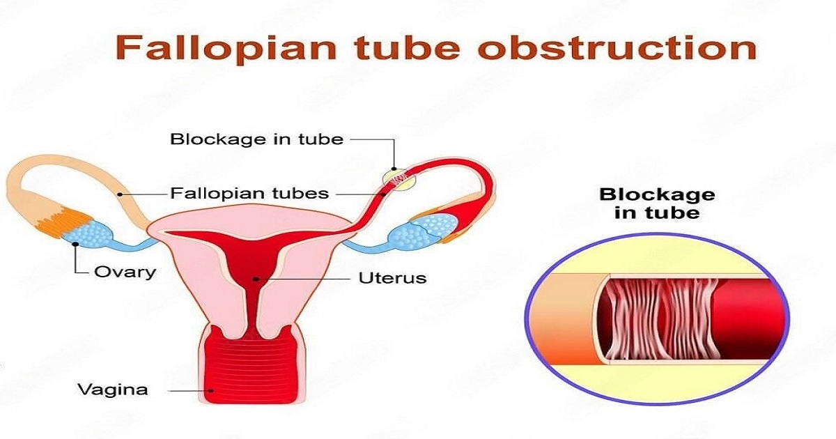 Pregnant with Blocked Fallopian Tubes