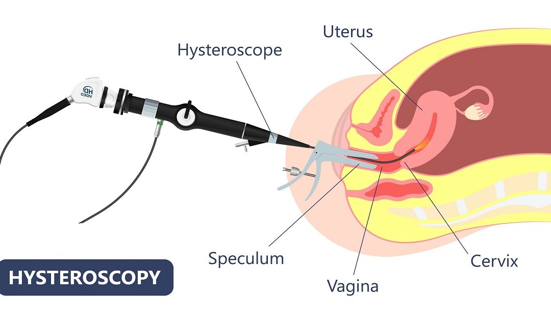 What is the Role of Hysteroscopy in IVF?