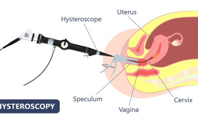 What is the Role of Hysteroscopy in IVF?