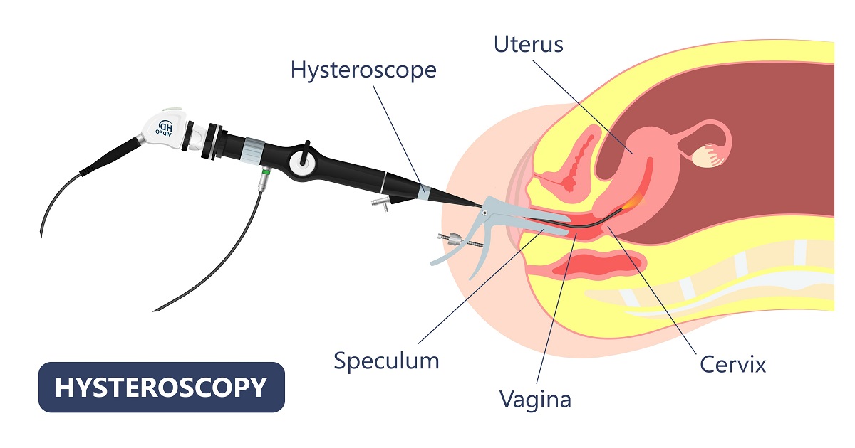 What is Hysteroscopy IVF?