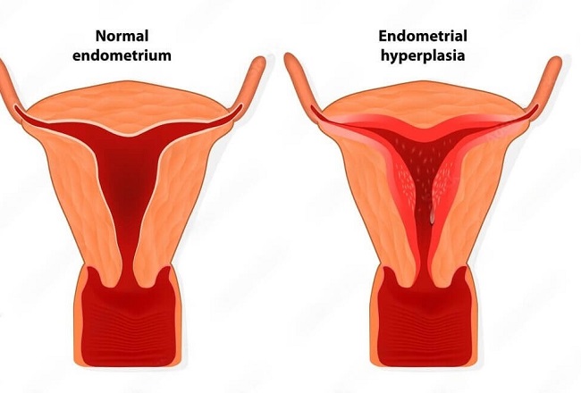 endometrial hyperplasia