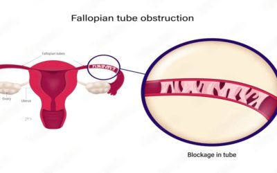 Fallopian Tube Blockage Treatment Options