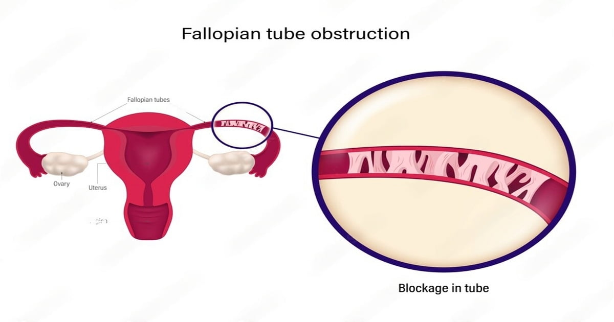 Fallopian tube blockage treatment