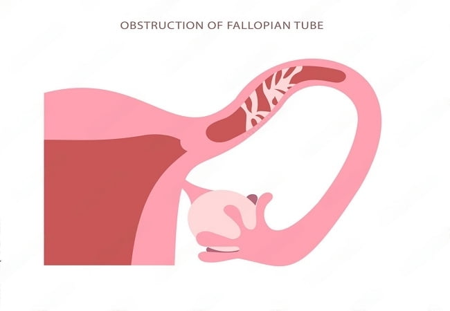 Fallopian tube blockage