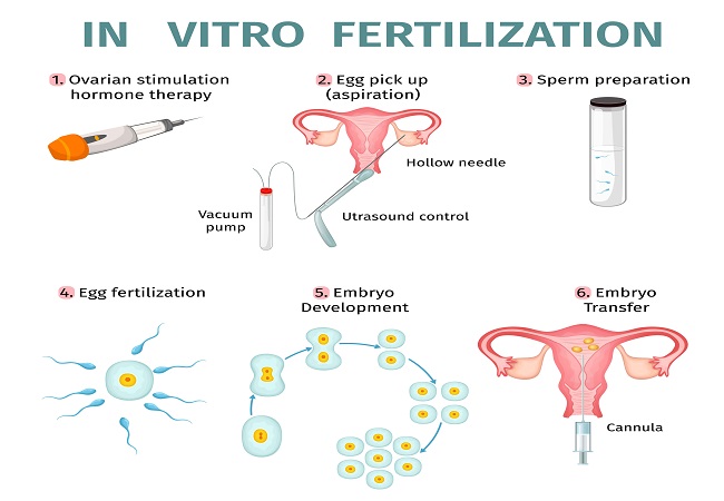 IVF