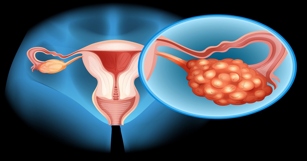 PCOD Problem Symptoms in Females