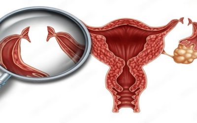 What are Tubectomy and Tubectomy Reversal?