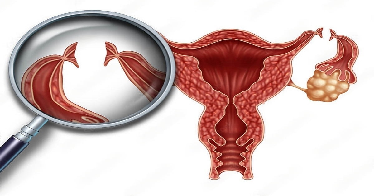 Tubectomy and Tubectomy Reversal