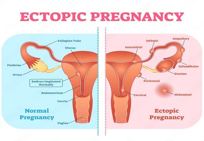 Ectopic Pregnancy