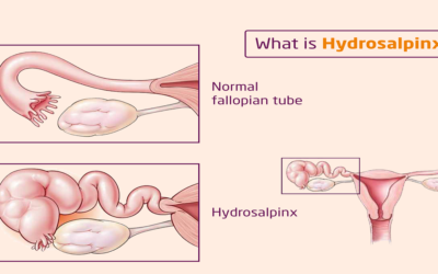 Hydrosalpinx: Symptoms, Causes and Treatment