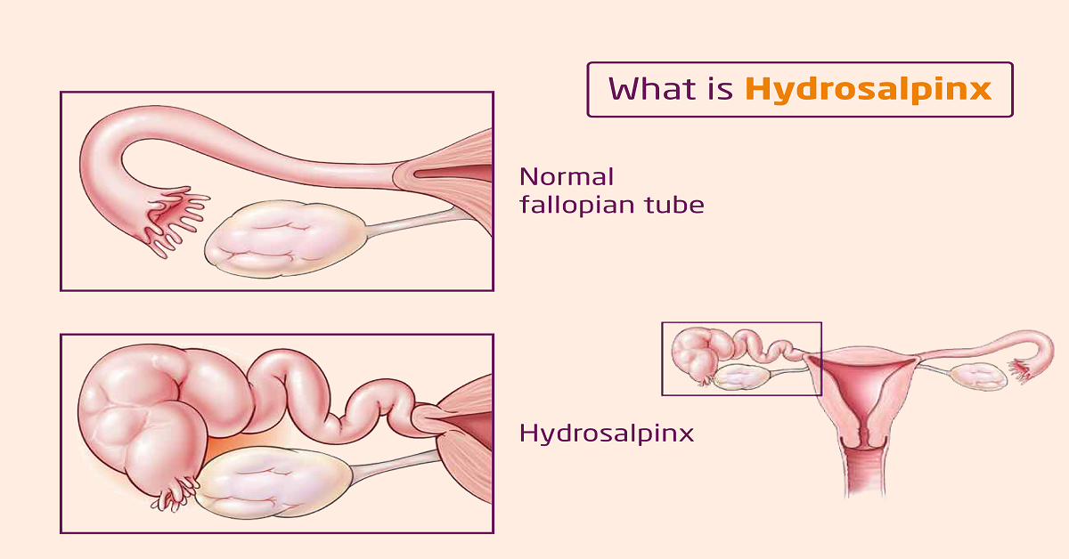 Hydrosalpinx Symptoms, Causes & Treatment