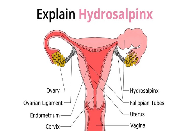 Hydrosalpinx