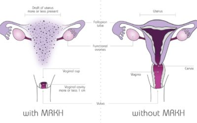 MRKH Syndrome: Symptoms, Causes & Treatment