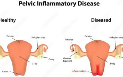 Pelvic Inflammatory Disease (PID): Causes And Treatment