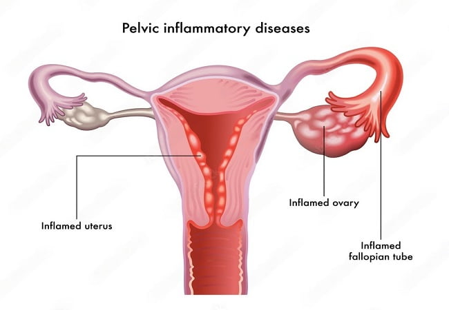 Pelvic Inflammatory Disease