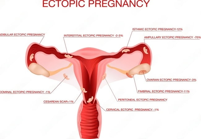 Types of Ectopic Pregnancy