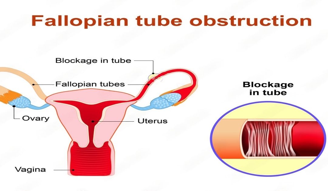 Unilateral Tubal Blockage: Causes, Symptoms & Treatment