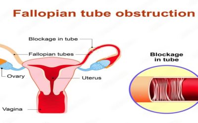 Unilateral Tubal Blockage: Causes, Symptoms & Treatment