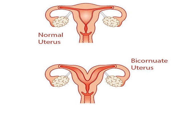 bicornuate uterus