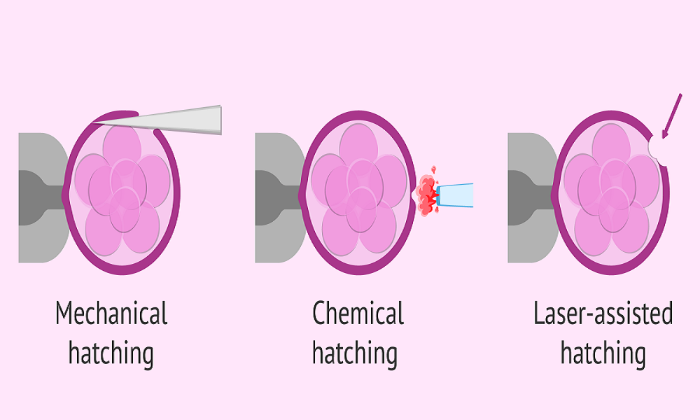 Assisted Hatching Methods