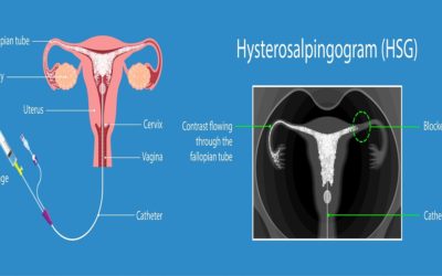 HSG Test for Infertility: Procedure, Advantages and Side effects