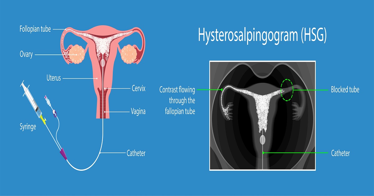 HSG Test- Procedure, Advantages and Side effects