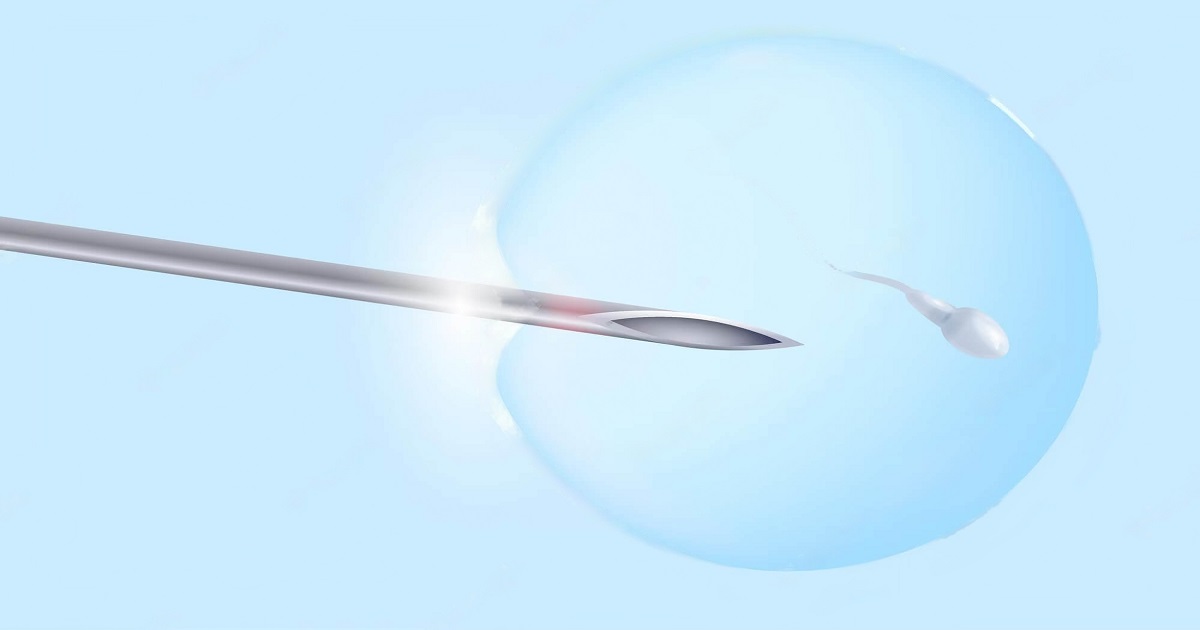 IVF with Laser Assisted Hatching