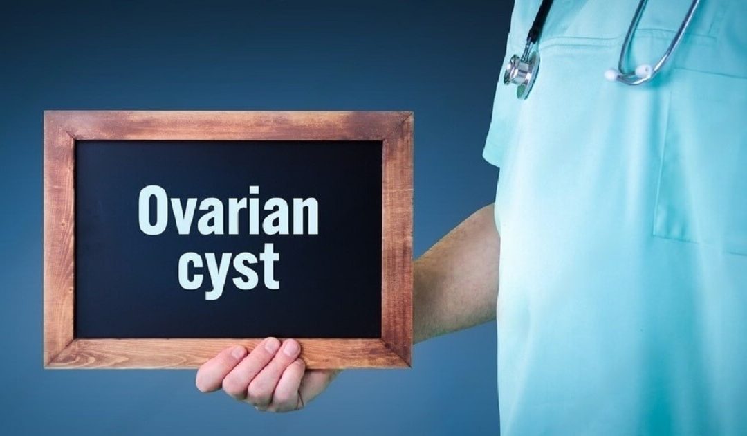 Ovarian Cyst: Symptoms, Treatment & Causes