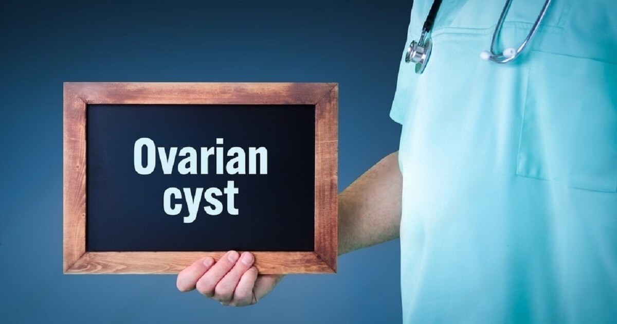 Ovarian Cyst Symptoms, Treatment & Causes