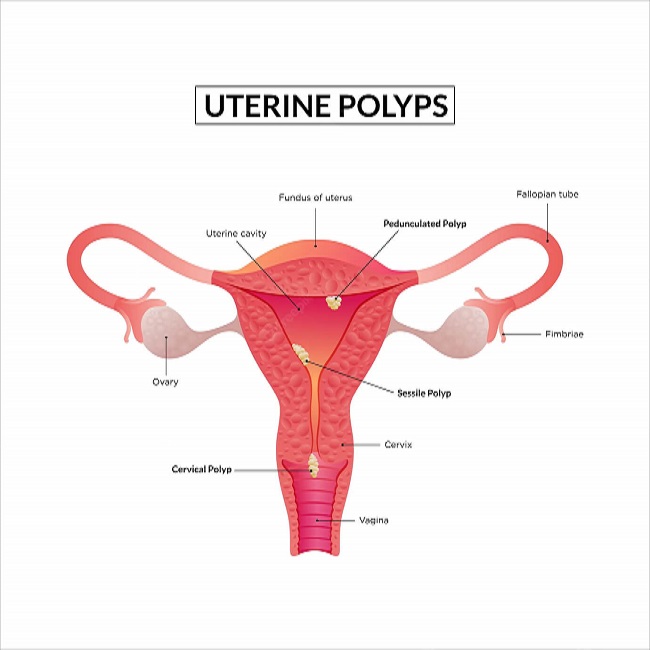 Endometrial/Uterine Polyps