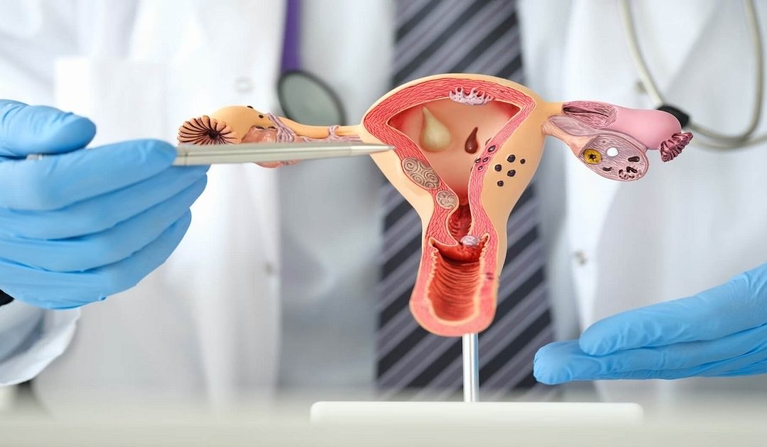 Endometrial/Uterine Polyps: Symptoms, Causes & Treatment