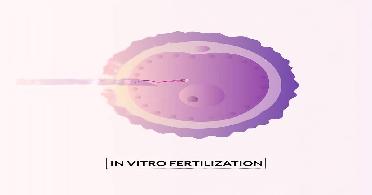 Mni IVF Process