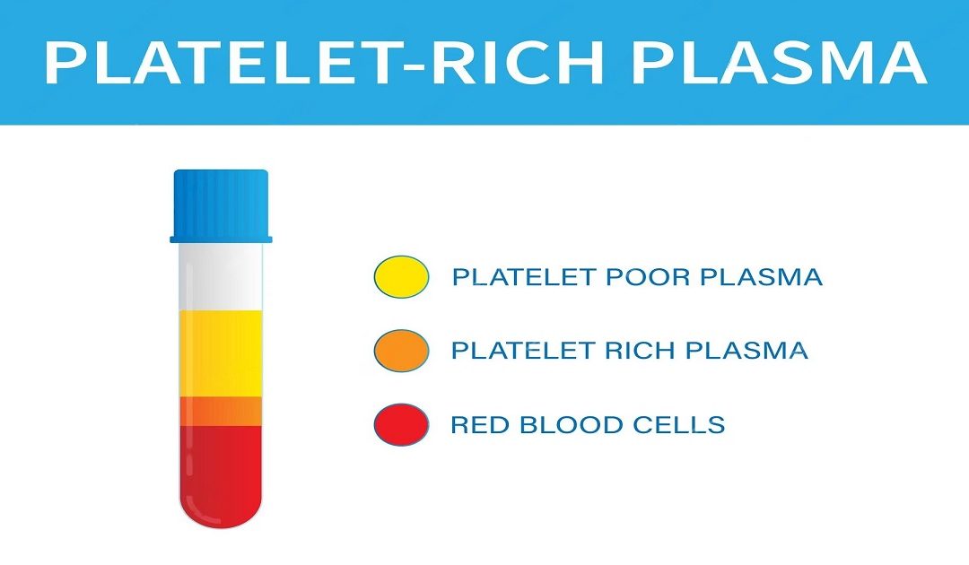 PRP Procedure in IVF for Infertility Treatment